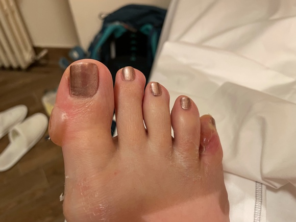 Toes with blisters